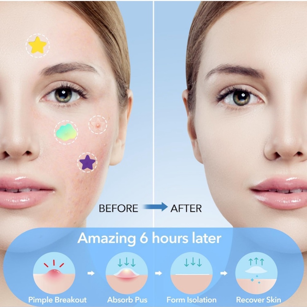 Pimple Patches for Face, Hydrocolloid Acne with Tea Tree Oil,  232pcs